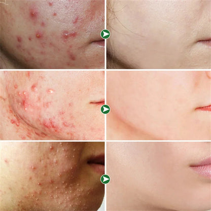 Salicylic Acid Acne Treatment Face Cream Repair Pimple Spots Deep Cleaning Pore Anti-acne Scar Oil Control Moisturizer Skin Care