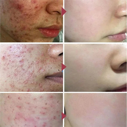 Salicylic Acid Acne Treatment Face Cream Repair Pimple Spots Deep Cleaning Pore Anti-acne Scar Oil Control Moisturizer Skin Care