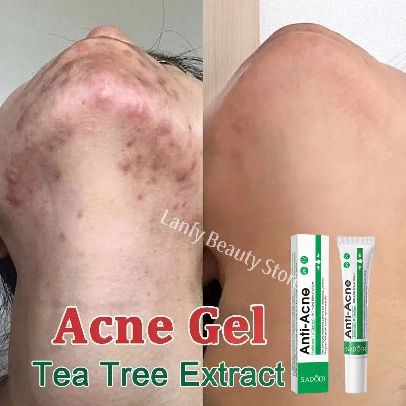 Salicylic Acid Acne Treatment Face Cream Repair Pimple Spots Deep Cleaning Pore Anti-acne Scar Oil Control Moisturizer Skin Care