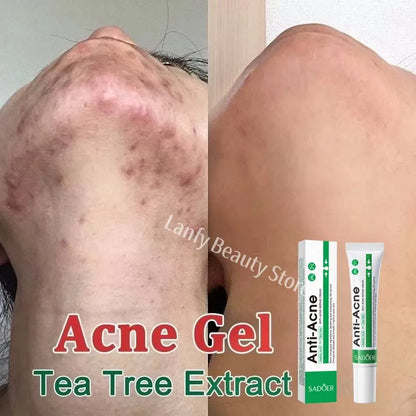 Salicylic Acid Acne Treatment Face Cream Repair Pimple Spots Deep Cleaning Pore Anti-acne Scar Oil Control Moisturizer Skin Care