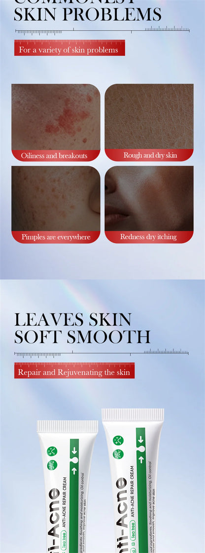 Salicylic Acid Acne Treatment Face Cream Repair Pimple Spots Deep Cleaning Pore Anti-acne Scar Oil Control Moisturizer Skin Care