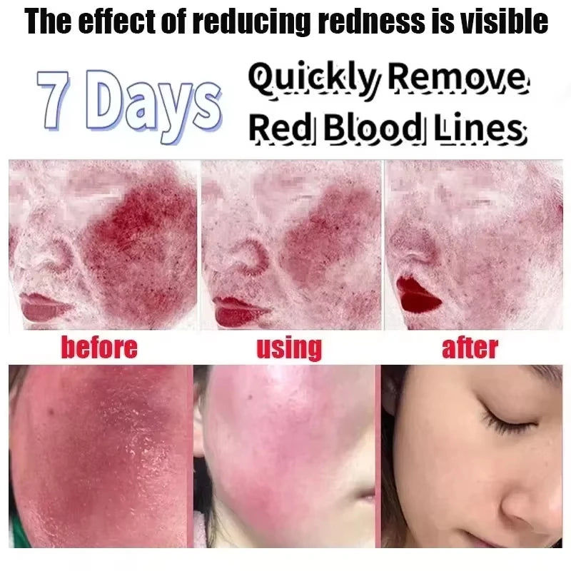 Facial Redness Repair Cream Improve Sensitive Skin Moisturizer Hydrate Sooth Lotion Removal Rosacea Spider Vein Korean Cosmetic